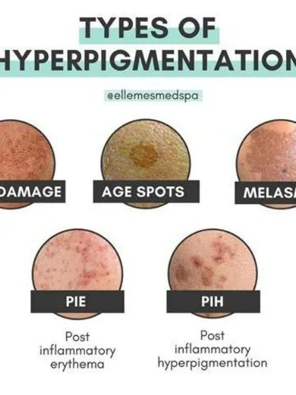 This graphic illustrates the different types of hyperpigmentation I treat, from sun damage and age spots to melasma and post-acne marks (PIE and PIH). A correct diagnosis of the type of pigmentation is essential for effective treatment.