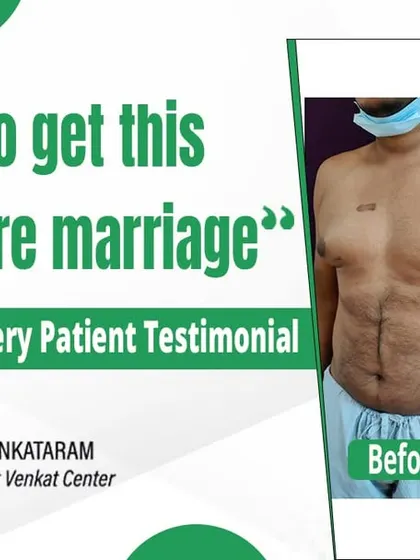 This patient wanted to get his gynecomastia surgery done before his marriage. The before and after photos show the significant, natural-looking improvement we can achieve.