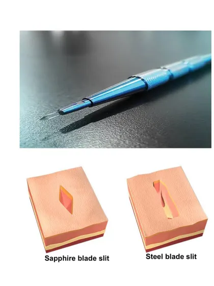 This diagram illustrates the advantage of using a Sapphire blade over a traditional steel blade for making incisions. The V-shaped slit created by the sapphire blade is smaller and allows for denser packing of grafts with less tissue trauma.