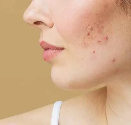 Acne is one of the most common and misunderstood skin conditions. A proper diagnosis and a scientifically-backed treatment plan are necessary to manage it effectively and prevent long-term issues like scarring.