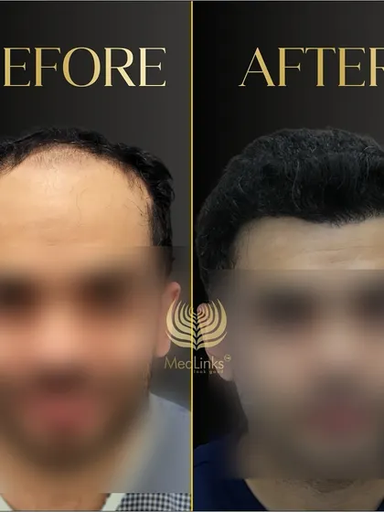 A before and after shot of a patient whose face is blurred for privacy, but the hair transformation is clear. The result is a full, natural-looking head of hair.