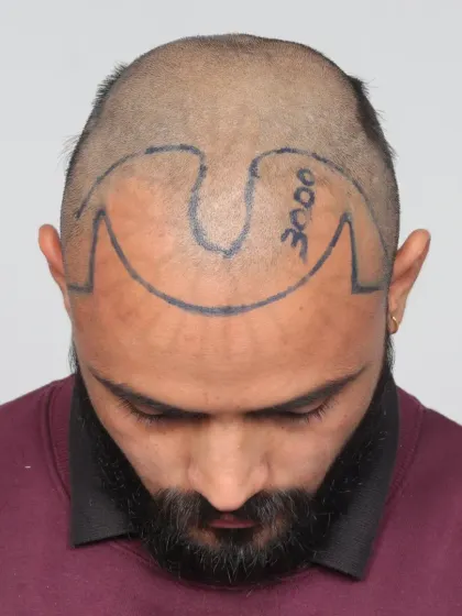 This shows the crucial first step: hairline design. We mark the area precisely to ensure the final result perfectly frames the face.
