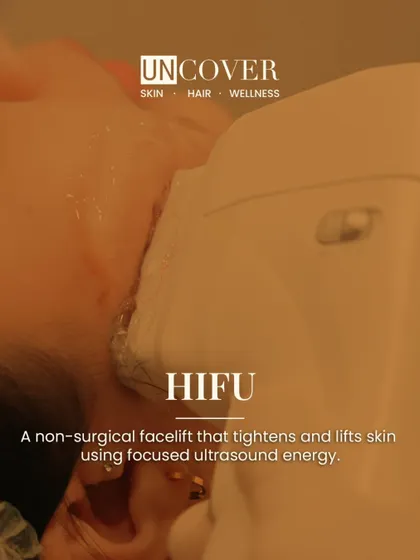HIFU is a non-surgical facelift that tightens and lifts skin using focused ultrasound energy. It's a classic, effective treatment for those looking for real, lasting results instead of fading fads.