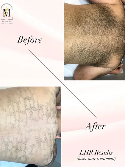 This treatment is highly effective for men too. This before and after shows the results of a laser hair treatment on a male client's back, demonstrating a dramatic reduction in hair density for a cleaner look.