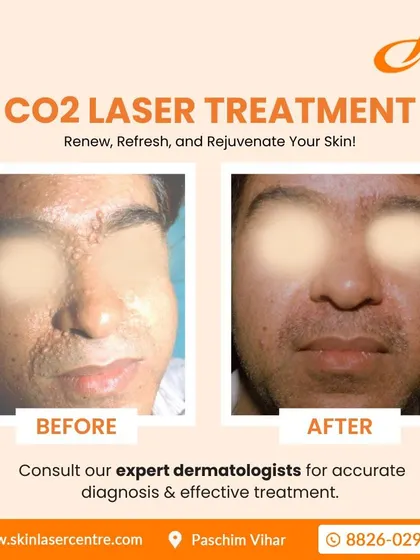 This before and after image shows the significant improvement possible with CO2 laser treatment. I used this precise laser to safely remove multiple growths from the patient's face, resulting in much smoother and clearer skin. This is a powerful tool for skin resurfacing.