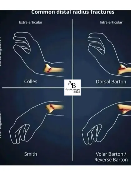 Wrist fractures can occur in several ways. This diagram illustrates common types like the Colles and Smith fractures, showing how the angle of the break differs. Proper diagnosis is critical for a successful recovery and regaining full hand function.