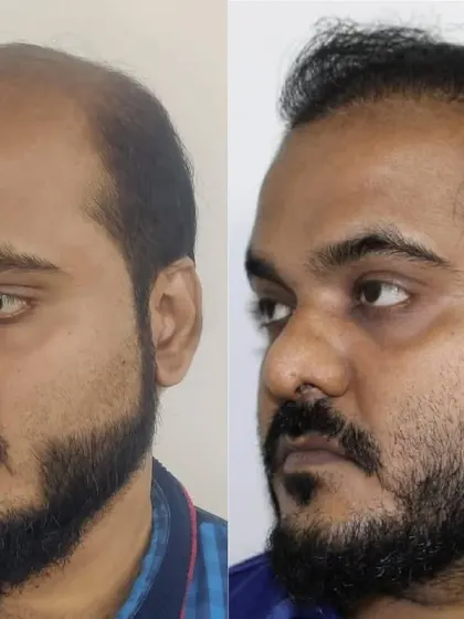 From the side, you can see the extent of the restoration, covering the frontal and mid-scalp regions effectively.