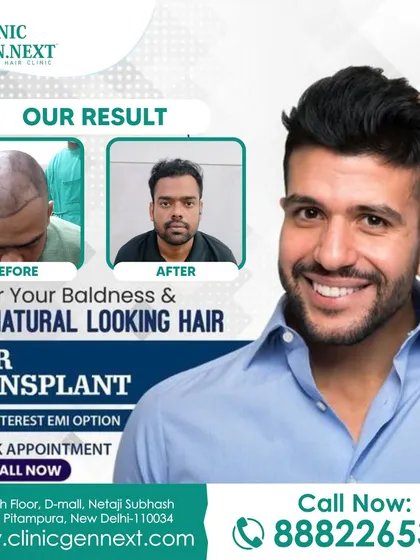 Here is another example of a patient's journey, covering his baldness and achieving natural-looking hair through my FUE hair transplant technique.