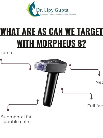 Morpheus8 is incredibly versatile. This image shows the different areas we can target, including the delicate eye area, the full face, the neck, and submental fat, which is commonly known as a double chin.