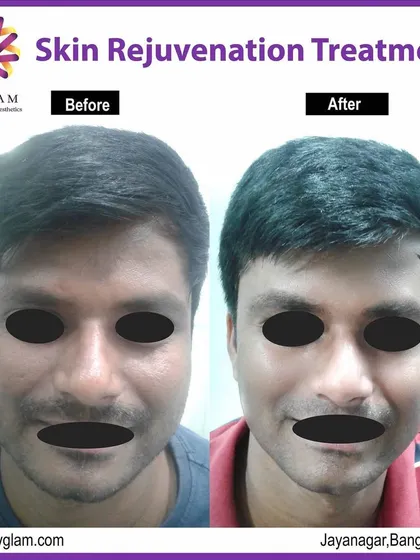 This male client received a skin rejuvenation treatment to address uneven skin tone and texture. The result is visibly clearer, smoother skin, showing that these treatments are highly effective for men as well.