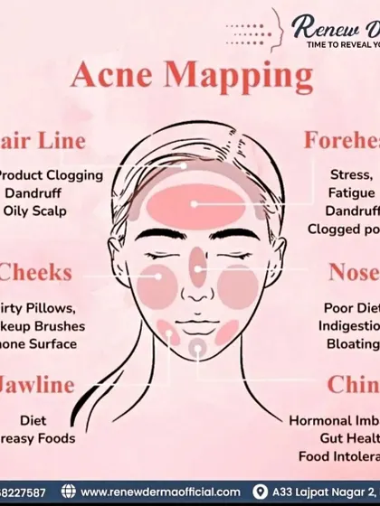 This acne face map helps identify potential underlying causes of breakouts based on their location, from stress-related forehead acne to hormonal chin acne.