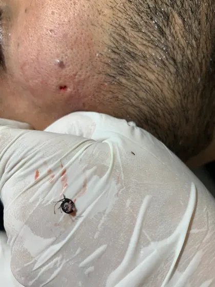 A close-up view of a successful ingrown hair clump removal. This common and often painful issue can be resolved with a precise in-clinic procedure, preventing further inflammation and potential scarring that can result from improper hair removal techniques.