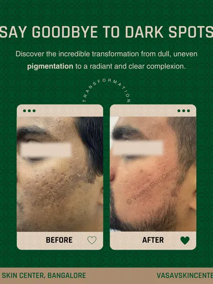This is another powerful example of scar and pigmentation treatment. The 'before' photo shows deep-set acne scars and significant dark spots. The 'after' photo reveals a much clearer and more radiant complexion. My goal is to not only reduce the scars but also to restore an even, healthy skin tone.