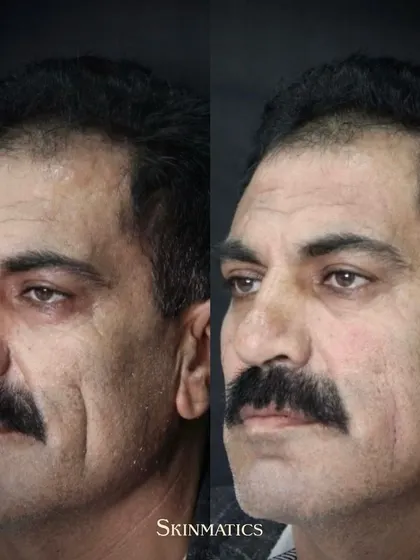 As we age, we can lose volume in key areas of the face. This image shows how fillers can be used to counteract age-related atrophy, restoring structure and fullness for a more youthful and rested look.