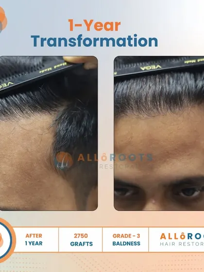 This one-year transformation for a Grade 3 baldness case was achieved with 2750 grafts. The series of photos demonstrates the significant improvement in density and hairline from every angle.
