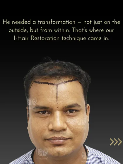 Kamlesh needed a transformation from the inside out. Our advanced I-Hair Restoration technique was the perfect solution, starting with the meticulous design of a new hairline that would frame his face naturally.