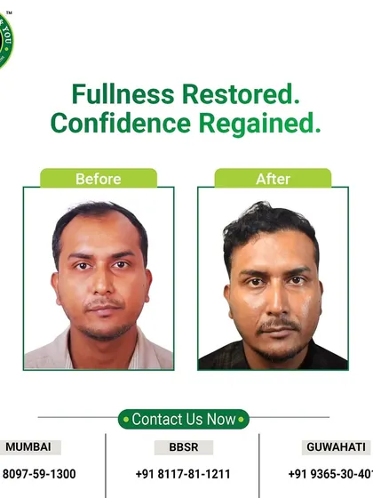 Fullness restored, confidence regained. This simple but powerful before and after image shows a clear improvement in hair density and a happier, more confident client.