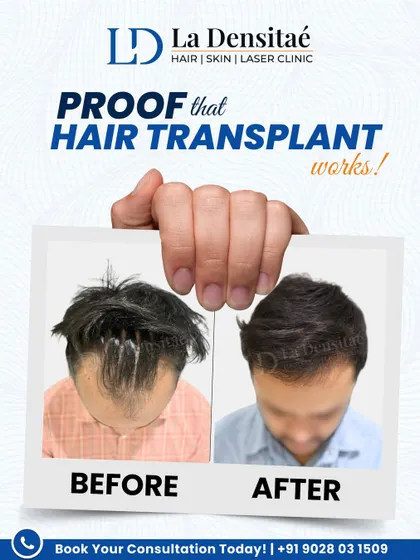 This patient tried to hide his receding hairline, but now he doesn't have to. After placing 2,879 grafts with the RT-FUE technique, his transformation is a testament to patience, planning, and trusting the process.