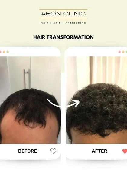 This before-and-after comparison clearly shows the successful restoration of a client's hair, resulting in a much fuller and healthier appearance.