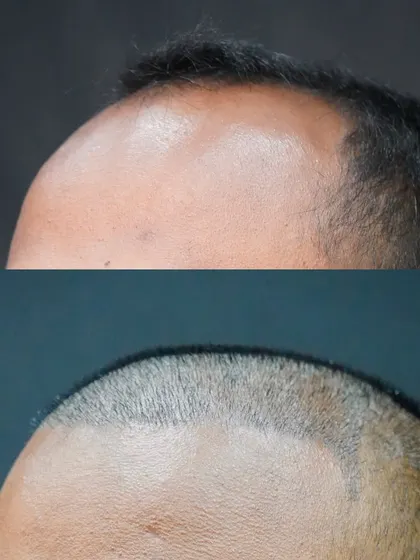 This before-and-after image shows the result just 10 days after a 4300-graft FUE procedure. You can see the newly designed, denser hairline that will frame the face and create a more youthful appearance.