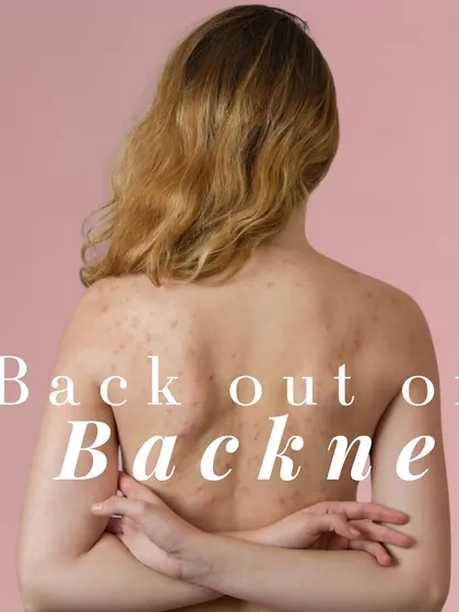 If you have back acne, or 'backne', we have solutions. Exfoliating toners, non-comedogenic lotions, and salicylic acid can help. For more severe cases, we offer clinical-level chemical peels with glycolic or lactic acid.