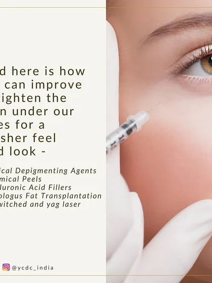 I offer several ways to improve and tighten the skin under your eyes, including topical agents, chemical peels, hyaluronic acid fillers, and Q-switched YAG laser treatments.