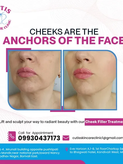 A powerful before-and-after comparison of our cheek filler treatment. This visual clearly shows how restoring volume to the cheeks acts as an anchor for the face, providing a visible lift and reducing sagging.