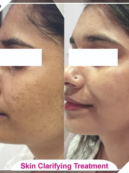 This side view demonstrates the effectiveness of our skin clarifying treatments in evening out skin tone and texture.