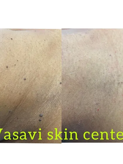 This image displays the successful clearance of multiple small skin tags from the neck and upper chest area. Even when numerous, each tag is treated individually to ensure a comprehensive and blemish-free outcome.