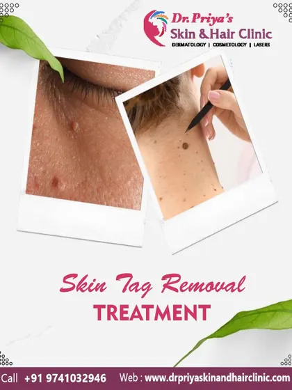 Skin tags are benign growths that can be easily and safely removed. My treatment approach focuses on providing a scar-free removal, helping you achieve smoother skin without any lasting marks.