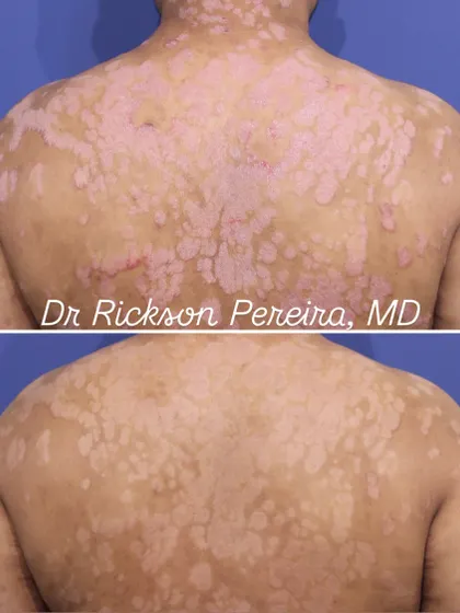 The patient's back shows a near-complete reduction in scaling and redness. This is what effective, evidence-based treatment looks like. It's not just about clearing the skin, but about giving patients their lives back.