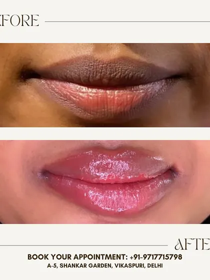 See the transformation with my permanent lip blush service. I corrected the dark pigmentation and gave her lips a beautiful, natural pink tint. This is perfect for anyone tired of reapplying lipstick and wanting an effortlessly defined look.