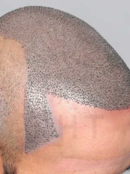 A high-grade baldness case just after surgery. 5700 grafts were used to recreate the hairline, frontal region, mid-scalp, crown, and temples.