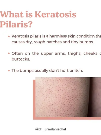 Keratosis pilaris is a harmless skin condition that causes dry, rough patches and tiny bumps, often on the upper arms, thighs, or cheeks. The bumps are caused by clogged hair follicles and usually don't hurt or itch, but they can be a cosmetic concern for many.