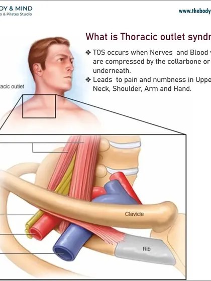 Thoracic Outlet Syndrome (TOS) occurs when nerves and blood vessels are compressed near the collarbone, causing pain and numbness in the arm and hand. I address this with specific postural and mobility work.
