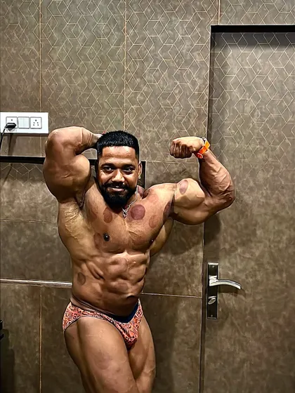 A front double bicep pose showing the after-effects of cupping therapy, a recovery technique we use.