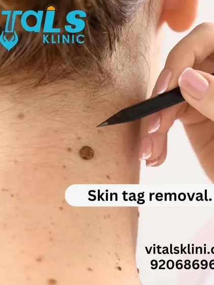 This image highlights our skin tag removal service. Skin tags are common and benign, and I remove them quickly and painlessly using methods like electrocautery for immediate results.