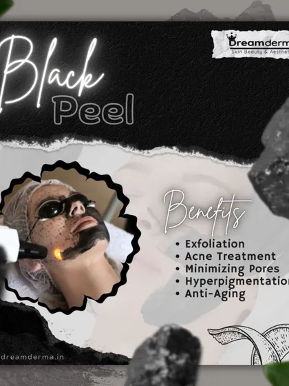 Our Black Peel treatment, a variation of the carbon peel, is a powerful solution for exfoliation, acne, minimizing pores, and reducing hyperpigmentation. It's an excellent anti-aging procedure for revitalizing your skin.