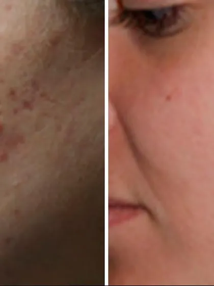 A fantastic result for a patient with persistent acne and early scarring. The treatment plan was designed to be gentle yet effective, focusing on clearing the active lesions while preventing future scars from forming.