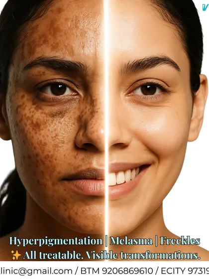 Hyperpigmentation and melasma are common concerns, especially for Indian skin. This before-and-after result demonstrates the effectiveness of a targeted treatment plan, which can include safe laser therapy and customized skincare to even out skin tone and restore a natural radiance.