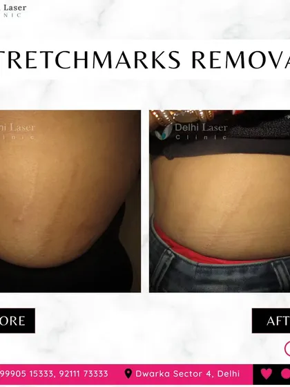 This image shows a significant reduction in the appearance of abdominal stretch marks after treatment. My approach helps to rebuild collagen and elastin, making the marks less visible and improving the skin's texture.