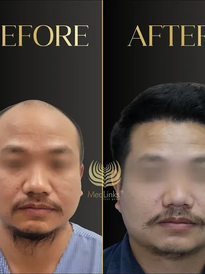 This before and after, with the patient's face blurred, shows a significant improvement in hair density and hairline design.