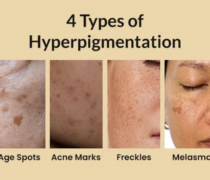 This image shows four common types of hyperpigmentation: age spots, acne marks, freckles, and melasma. I provide specialized treatments for each of these, ensuring you get the right care for your specific concern.