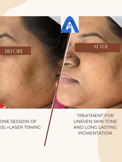 Another angle showing the improvement in facial pigmentation after a single session of a peel and laser toning. This combination helps break down pigment and exfoliate the skin for faster results.