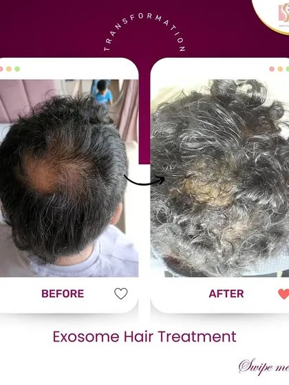 This is the kind of transformation that makes my work so rewarding. Using a science-backed Exosome treatment plan, we were able to significantly improve hair density and coverage for this client, addressing the thinning at the crown and restoring his confidence.