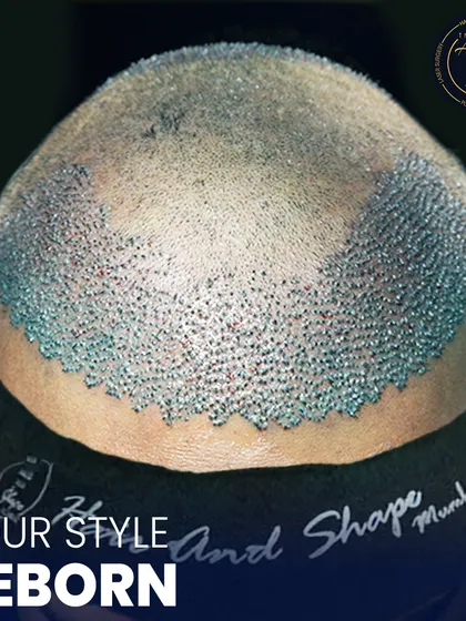 This is where science meets style. A detailed view of newly implanted hair follicles, showcasing the meticulous process of high-density hair restoration.
