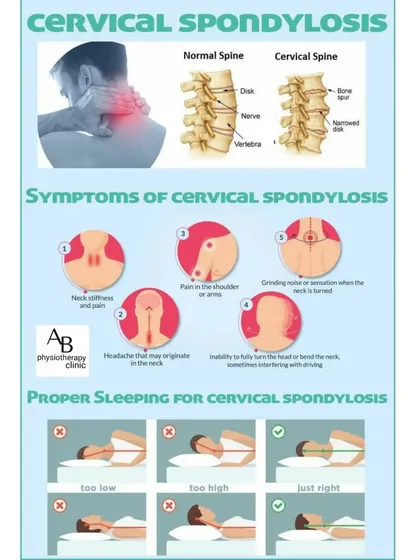This chart explains Cervical Spondylosis, or arthritis of the neck. It shows the symptoms, from neck stiffness to headaches, and illustrates how proper sleeping posture is crucial for managing the condition.