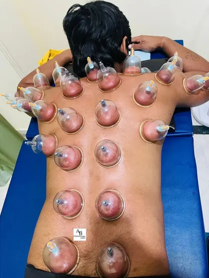 Here is a patient undergoing a full-back dry cupping session. The cups create suction to lift tissue, which helps to decompress the underlying muscles and fascia, providing significant relief from stiffness.