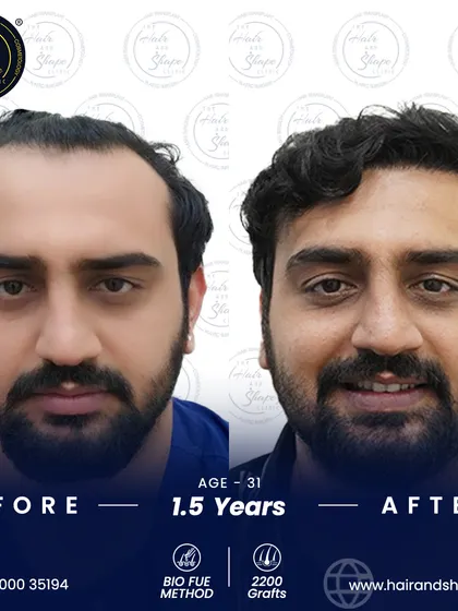 A frontal view showcasing the fantastic, mature result 1.5 years after a BIO FUE hair transplant, giving the patient a timeless and confident look.