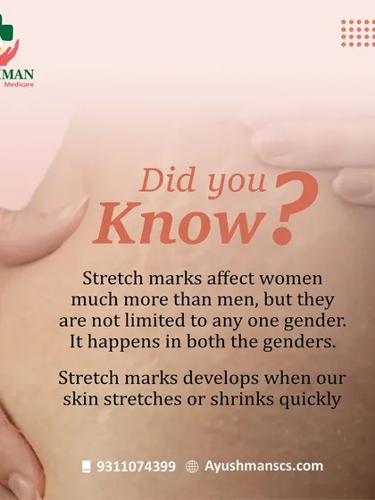 Did you know that stretch marks can affect both men and women? This informational post debunks common myths and explains that these marks develop when our skin stretches or shrinks quickly. We offer treatments to reduce their appearance.
